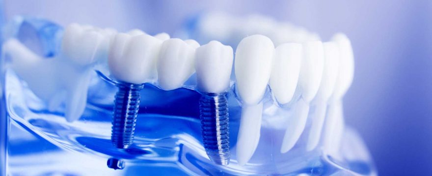Dental Implants